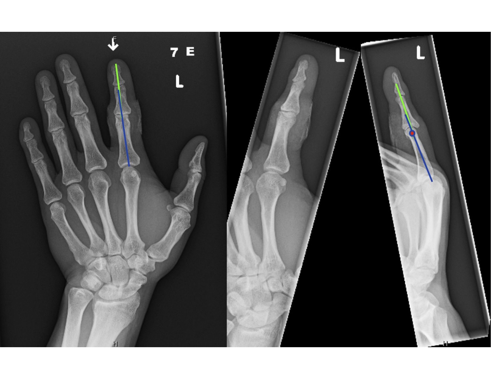 Dorsal Fracture Dislocations Of The Proximal Interphalangeal Joint ...